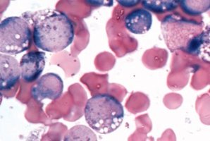 Острый лимфобластный лейкоз