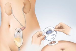 Операции при раке мочевого пузыря в Израиле