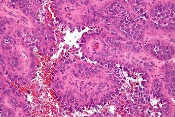 лечение ангиосаркомы