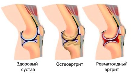 Лечение ревматоидного артрита в Израиле