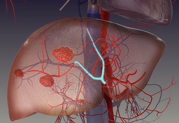 Эмболизация сосудов печени в Израиле