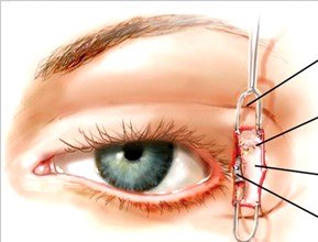 Блефаропластика в Израиле