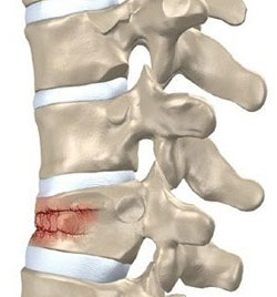 Лечение переломов позвоночника