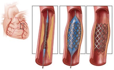 Операция стентирование   