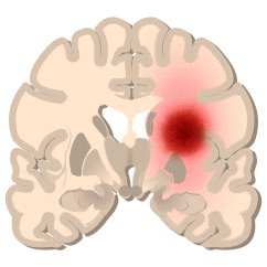 опухоль мозга израиль