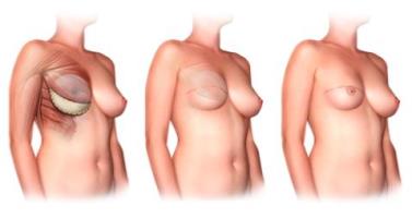 Восстановление молочной железы 