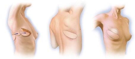 восстановление молочной железы после мастэктомии