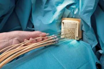 Брахитерапия в Израиле, цены