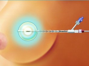 Брахитерапия-MammoSite лечение рака молочной железы в израиле
