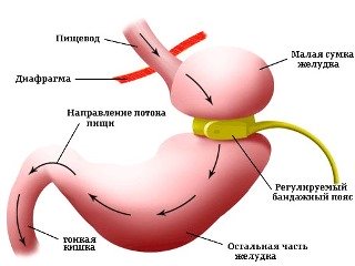 Операции при диабете 2 типа