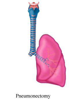 Пневмонэктомия 