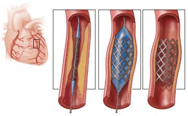 Операция стентирование   