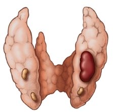 опухоль паращитовидных желез
