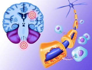 рассеянный склероз